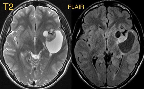 Daniel Gewolb MD On Twitter Imaging Variable And Can Look Very