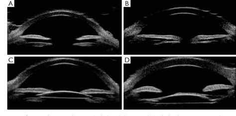 Table 1 From Ultrasound Biomicroscopy For The Assessment Of