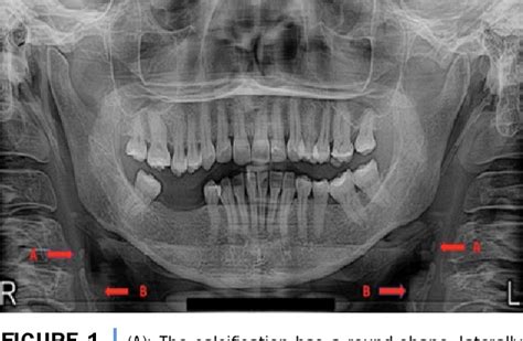 Triticeal cartilage calcification : radiographic features in plain radiographs | Semantic Scholar