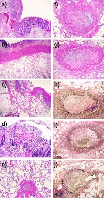 Histology Of The Resected Recto Sigmoid Colon A Scanning Power View Download Scientific