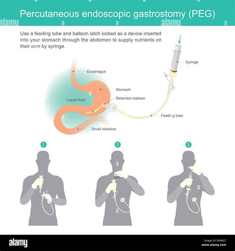 Medical feeding tube placement hi-res stock photography and images - Alamy