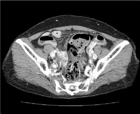 Pdf A Case Of Stercoral Perforation Of Sigmoid Colon Diagnosed By Colonoscopy Semantic Scholar