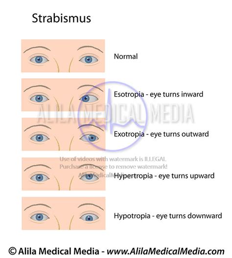 Alila Medical Media Strabismus Medical Illustration