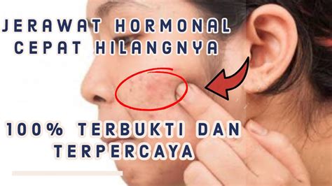 Cara Menghilangkan Jerawat Hormonal Dalam Sehari Sembuh Total Dengan