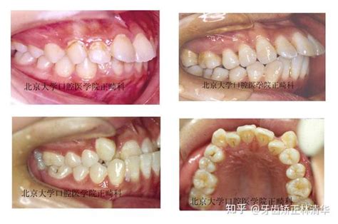 错颌畸形的分类 Angle错合分类法 知乎