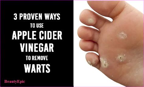 How Does Apple Cider Vinegar Get Rid of Warts?