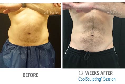 Coolsculpting Before And After Photos Incredible Outcomes