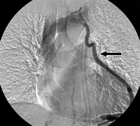 Balloon Occluded Retrograde Transvenous Obliteration Of Gastric Varices