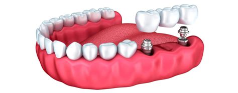 Implantes Carga Imediata Neo Joinville