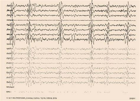 Eeg Showing Periodic Discharges Download Scientific Diagram