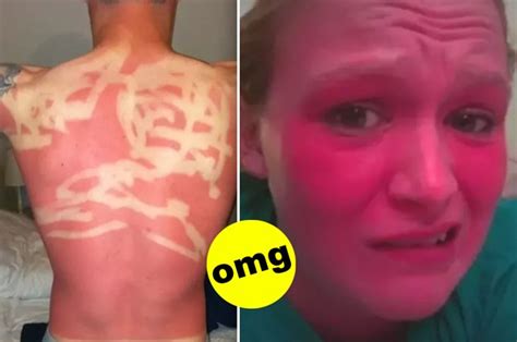 Show Us A Picture Of Your Worst Sunburn Ever