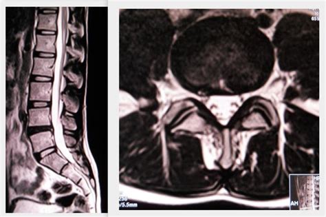 MRI T2WI lumbosacral spine showing disc desiccation at L4-5 causing ...