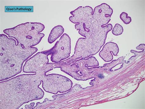 Qiao s Pathology Gallbladder Cholesterol Polyp 乔氏病理学胆囊胆 Flickr