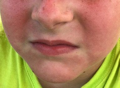 Cold Urticaria On Face