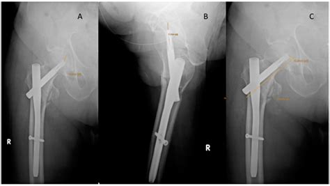 Cpt Code For Revision Intramedullary Nail Femur Bios Pics