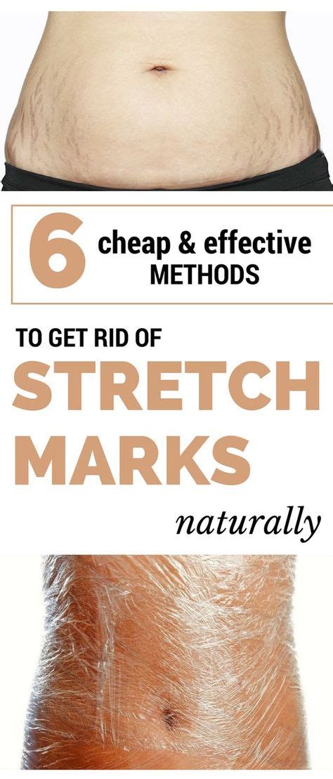 Cheap Effective Methods To Get Rid Of Stretch Marks Naturally