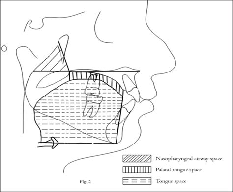 Evaluation And Correlation Between Pharyngeal Space Mandible And