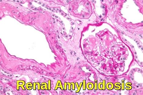 Amyloidosis Ask Hematologist Understand Hematology