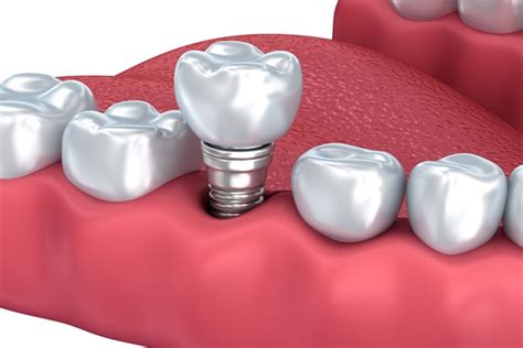 Reasons To Consider Getting Dental Implants From A Periodontist