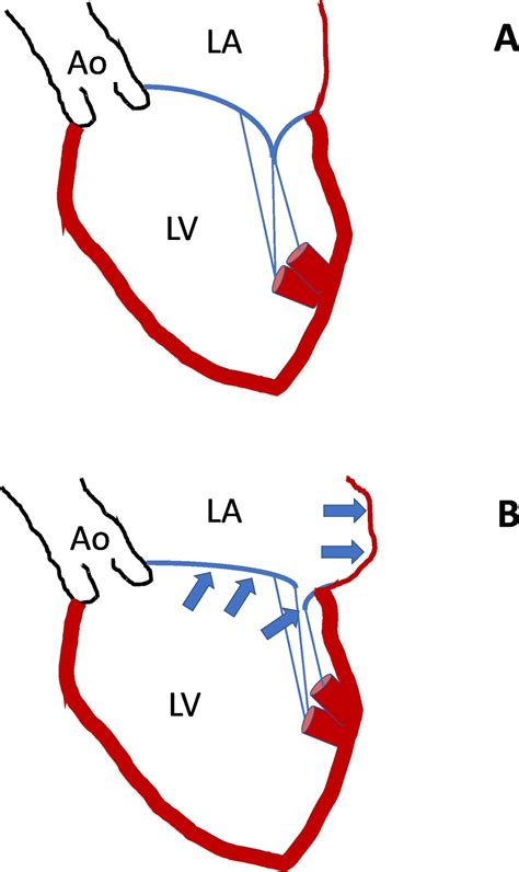 Atrial Functional Mitral Regurgitation A Relavant Factor For Fibrillatory Atrial Cardiomyopathy