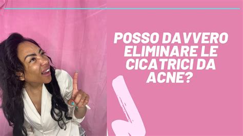 Come Ho Eliminato Le Cicatrici Da Acne Metodo Efficace Per Eliminare