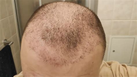 2 Hair Transplant S 2 Months Update SHOCK LOSS YouTube