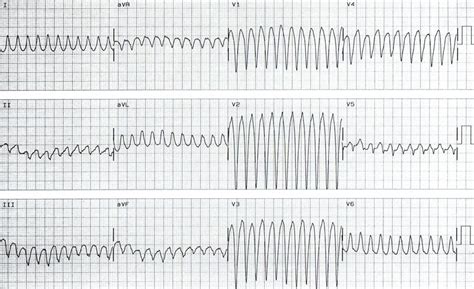 Naxos Disease (Naxos Arrhythmogenic Cardiocutaneous Syndrome ...