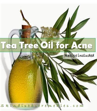 Tea Tree Oil for Acne with Recipe to Use it - Skin Disease Remedies