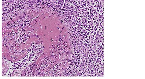 Necrotizing Vasculitis