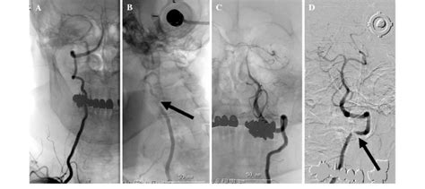 Preoperative Cerebral Angiograms Of The Right VA Show Normal Flow In