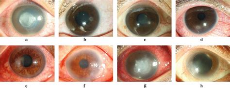 Representative Photographs Of Microbial Keratitis Caused By Bacterial Download Scientific