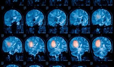 Tumor cerebral - síntomas, causas y tratamientos - Panel de Salud