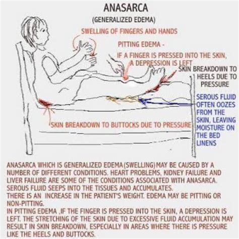 Anasarca Definition Causes And Treatment