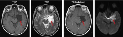 Intracranial Epidermoid Cyst Radiology Cases