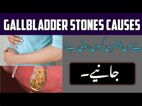 Gallbladder Stones Symptoms Pittay Ki Pathri Ka Ilaj In Urdu