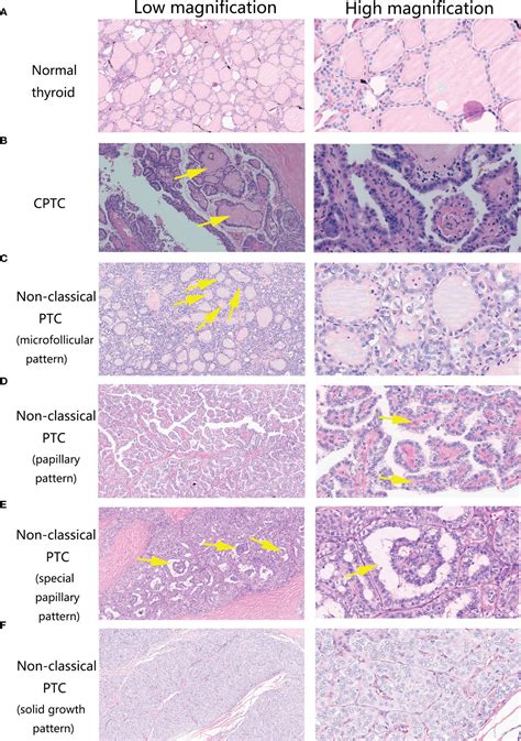 Frontiers Molecular And Clinical Features Of Papillary Thyroid Cancer