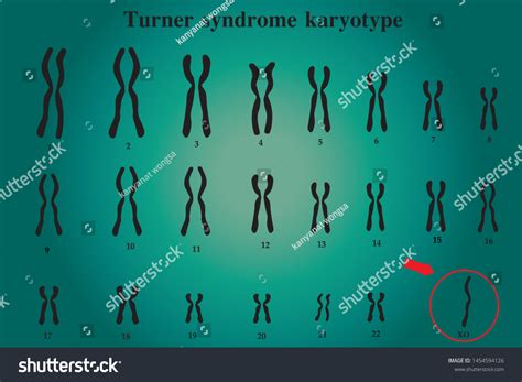 Turner Syndrome Male Karyotype