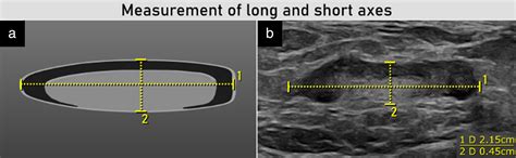 Terms Definitions And Measurements To Describe Sonographic Features Of Lymph Nodes Consensus