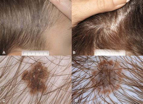 Scalp nevi in children. (A and B) brown pigmented macule on hair... | Download Scientific Diagram