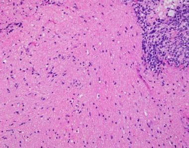 Pathology Of Embryonal Tumors Overview Pathophysiology And Etiology