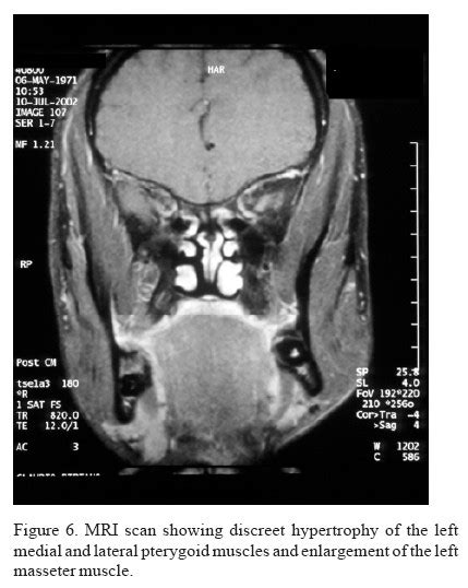 Scielo Brasil Masseter Muscle Hypertrophy Case Report Masseter Muscle Hypertrophy Case Report