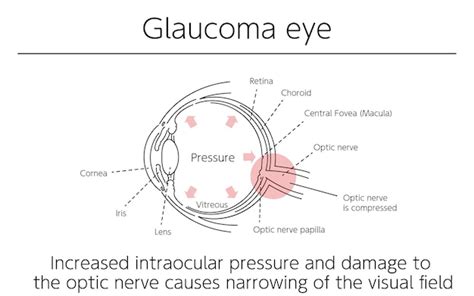 Ilustración Glaucoma Del Ojo Ilustraciones Médicas Vector Premium