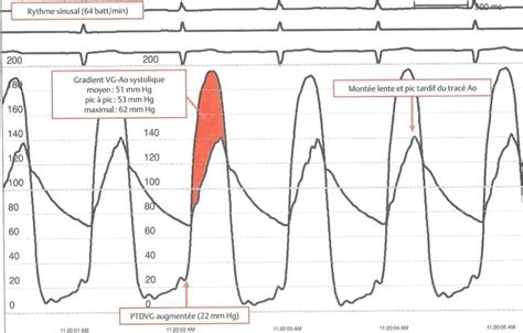 La Ventriculographie Gauche Cardio Paramed Cardio Paramed