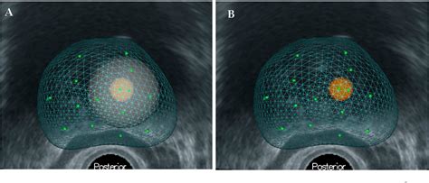 Figure 2 From Perilesional Targeted Biopsy Combined With MRI TRUS Image