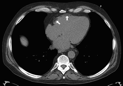 Ct Imaging Features And Frequency Of Left Ventricular Myocardial Fat In Patients With Ct