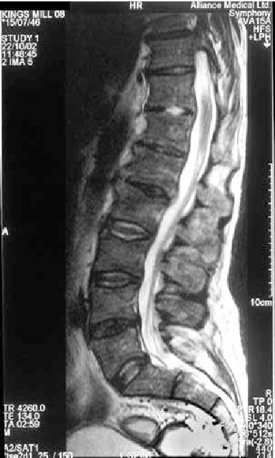 Figure From Multilevel Vertebral Osteomyelitis And Facet Joint