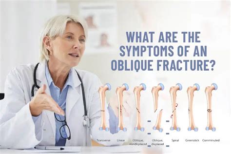 Oblique Fractures Unveiled A Comprehensive Guide