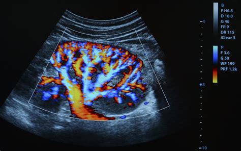 Kidney Anatomy Ultrasound