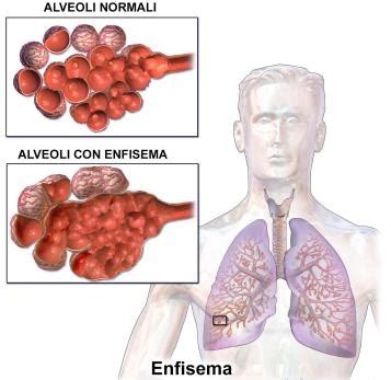 Enfisema Polmonare Medicina Chirurgia