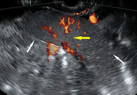 Doppler Enhanced Transvaginal Ultrasonography Revealed Central